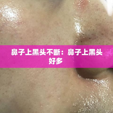 鼻子上黑头不断：鼻子上黑头好多 