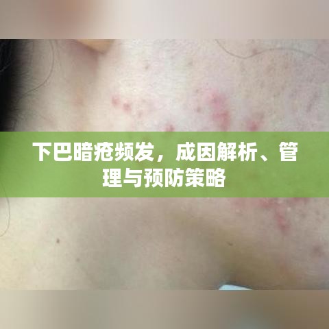 下巴暗疮频发，成因解析、管理与预防策略