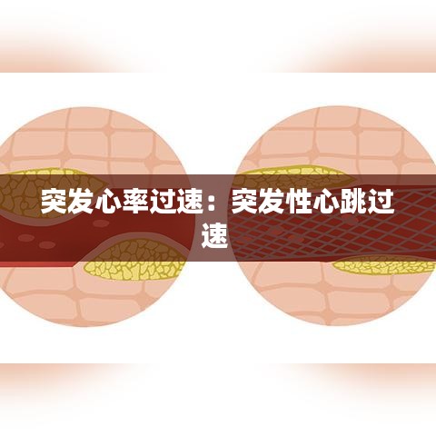 突发心率过速：突发性心跳过速 