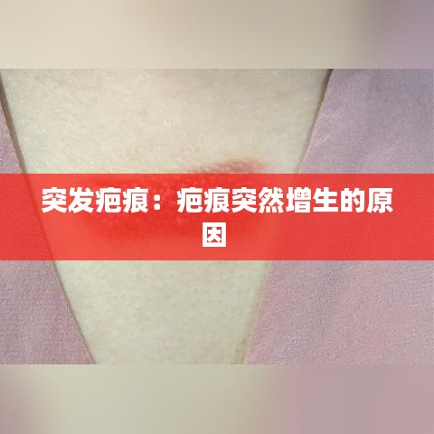 突发疤痕：疤痕突然增生的原因 