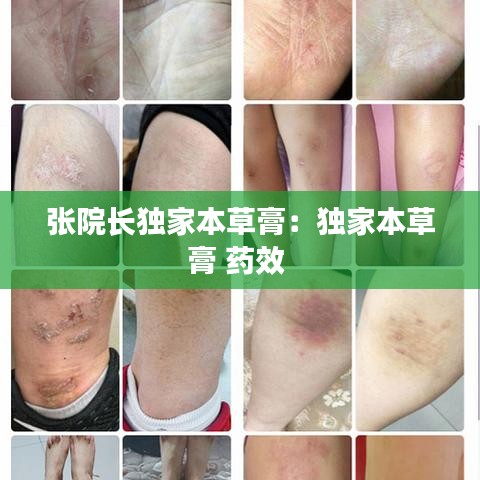 张院长独家本草膏：独家本草膏 药效 