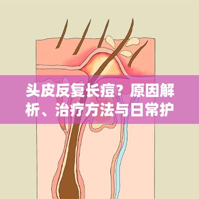 头皮反复长痘？原因解析、治疗方法与日常护理攻略！