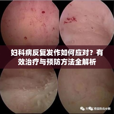 妇科病反复发作如何应对？有效治疗与预防方法全解析